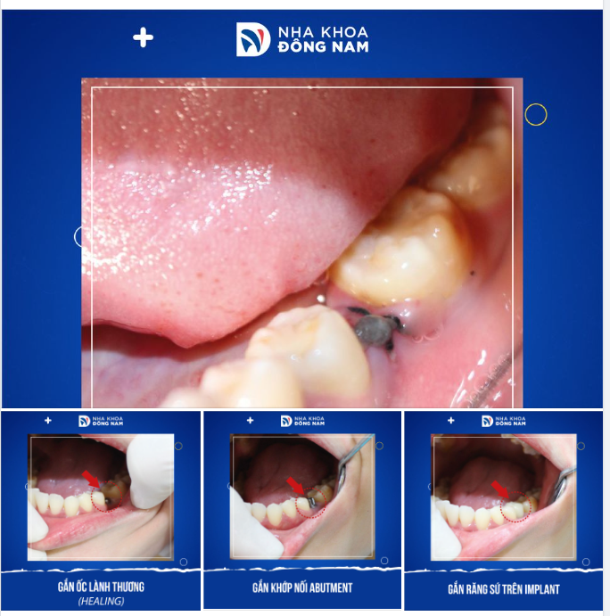 ĐIỀU KIỆN NÀO ĐỂ GẮN RĂNG HOÀN TẤT SAU 4 TUẦN ĐẶT TRỤ IMPLANT?