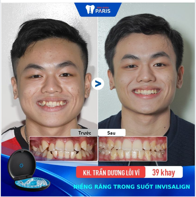 Điều trị sai khớp cắn, làm đều răng chen chúc với khay niềng INVISALIGN.