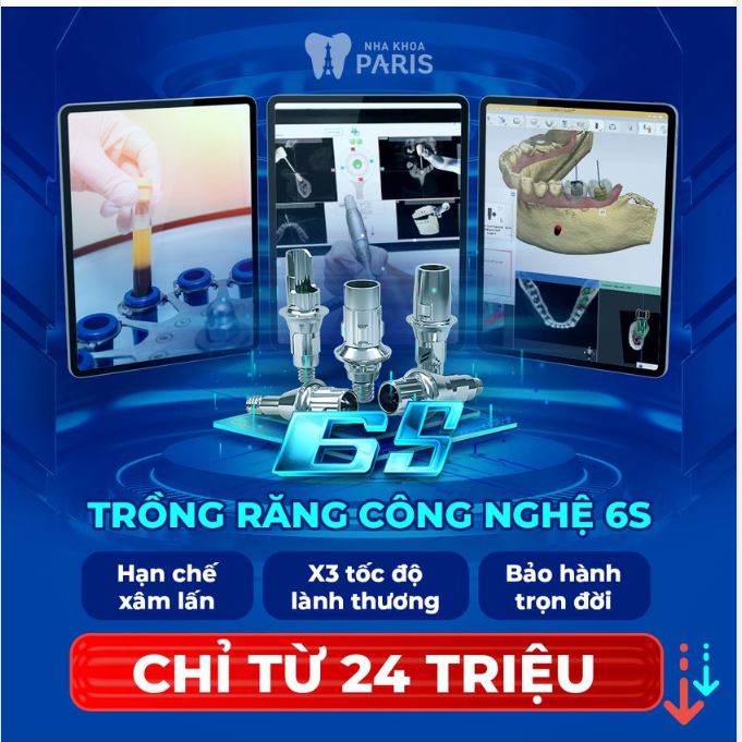 ĐỘT PHÁ CÔNG NGHỆ TRỒNG RĂNG IMPLANT 6S TIÊN TIẾN BẬC NHẤT HIỆN NAY