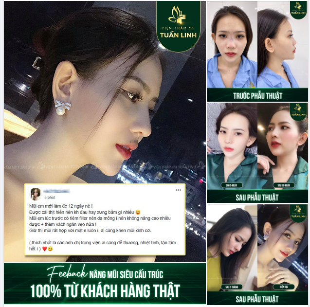 Feedback đầy yêu thương của khách hàng sau nâng mũi tại Tuấn Linh!!!