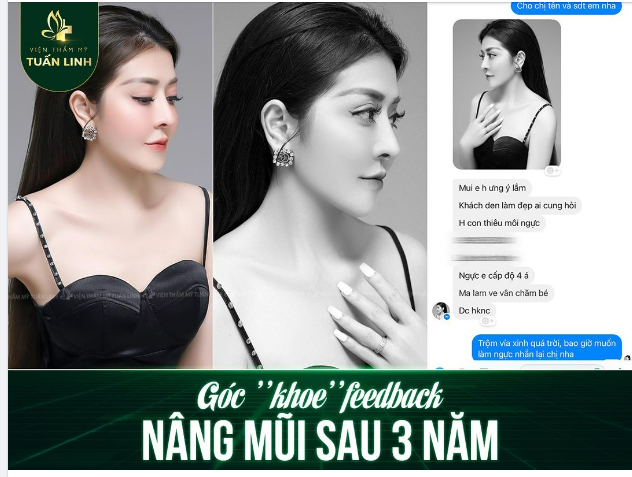 Feedback nâng mũi sau 3 năm tại Tuấn Linh