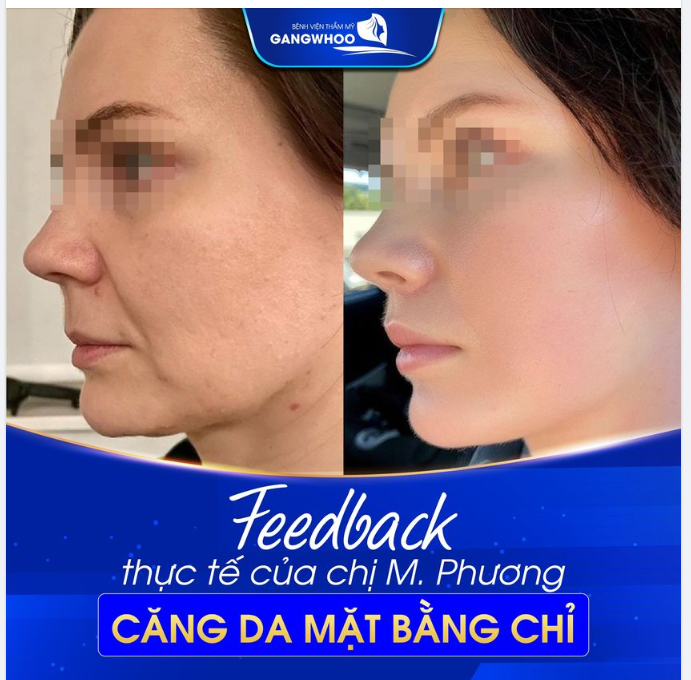 FEEDBACK THỰC TẾ CỦA KHÁCH HÀNG SAU KHI CĂNG DA MẶT BẰNG CHỈ