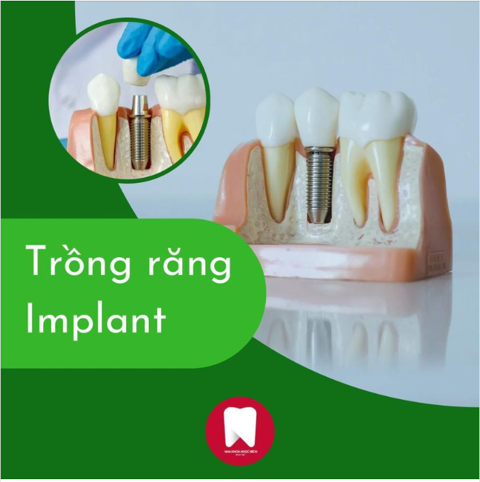 GIẢI PHÁP VÀNG CHO NGƯỜI M ẤT RĂNG