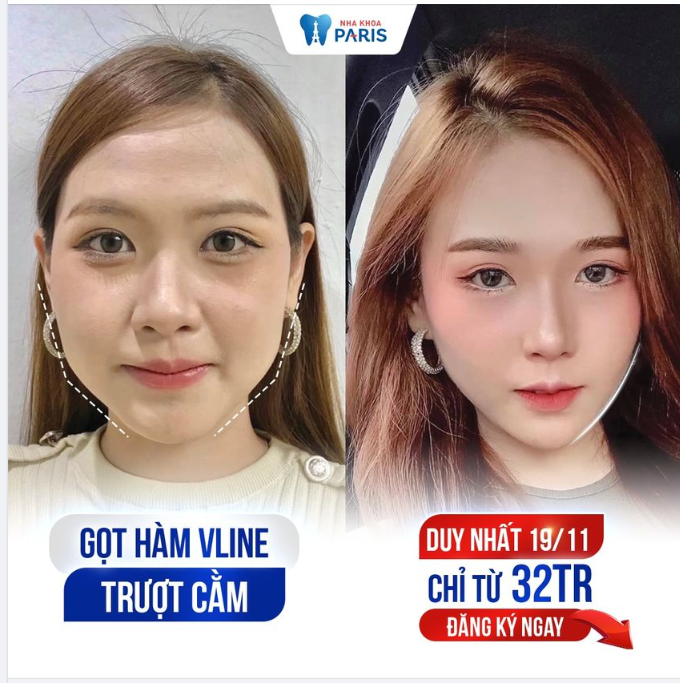 Gọt Hàm, Trượt Cằm, ĐẸP KỊP TẾT