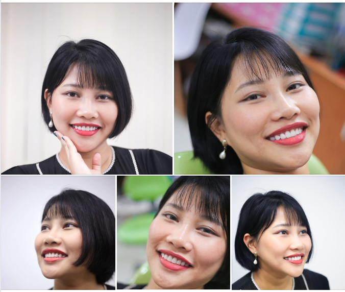 HÀI LÒNG TUYỆT ĐỐI SAU KHI SỞ HỮU NỤ CƯỜI MỚI