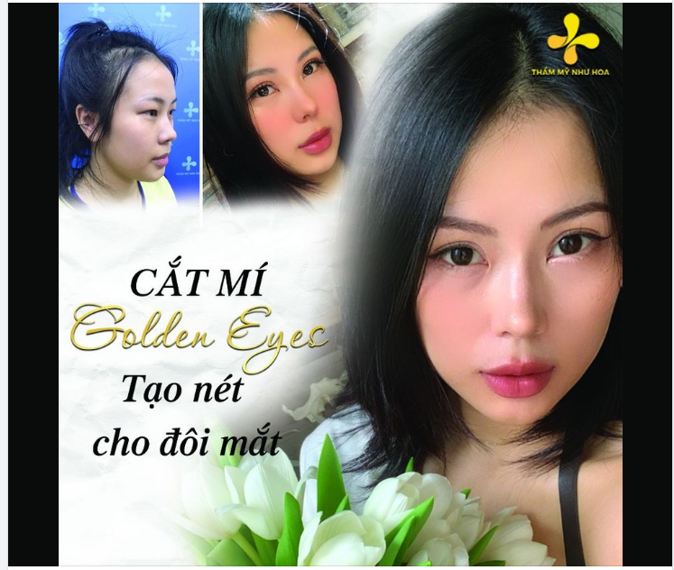 Hai mí đẹp tự nhiên – Đón đầu xu hướng thẩm mỹ hiện đại
