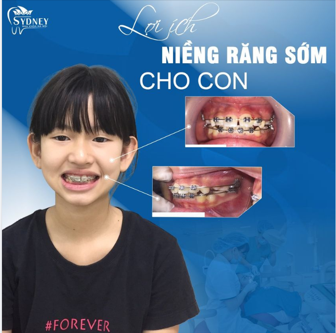 Hàm răng con xinh – Lung linh đón Tết