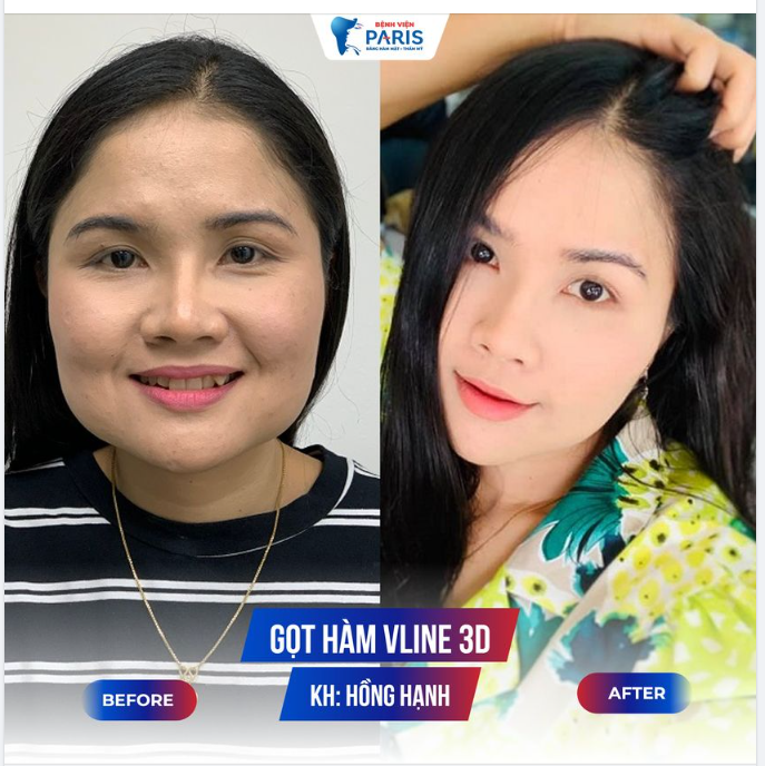 Hàm Vline chỉ sau 2h phẫu thuật - Mặt đẹp tự tin sau 10 ngày