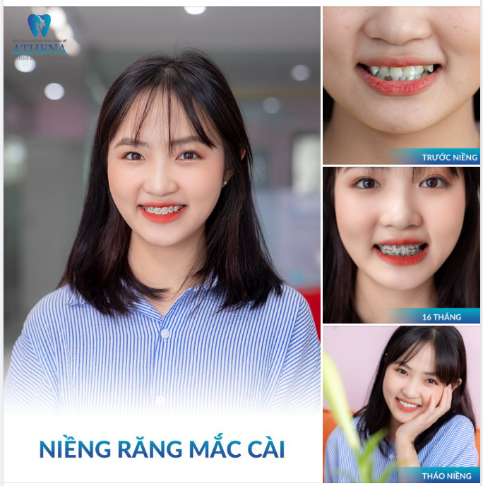 Hãy ngắm nhìn nụ cười mới của khách hàng Trịnh Khánh Ly sau 18 tháng niềng răng mắc cài kim loại tại ATHENA để thấy được sự thay đổi tuyệt vời này nhé!