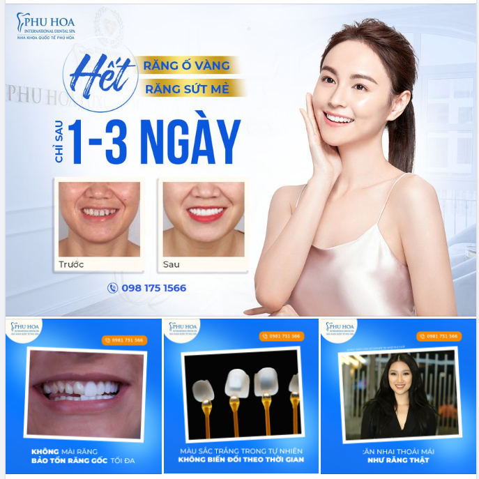 HẾT RĂNG Ố VÀNG, SỨT MẺ CHỈ SAU 1- 3 NGÀY