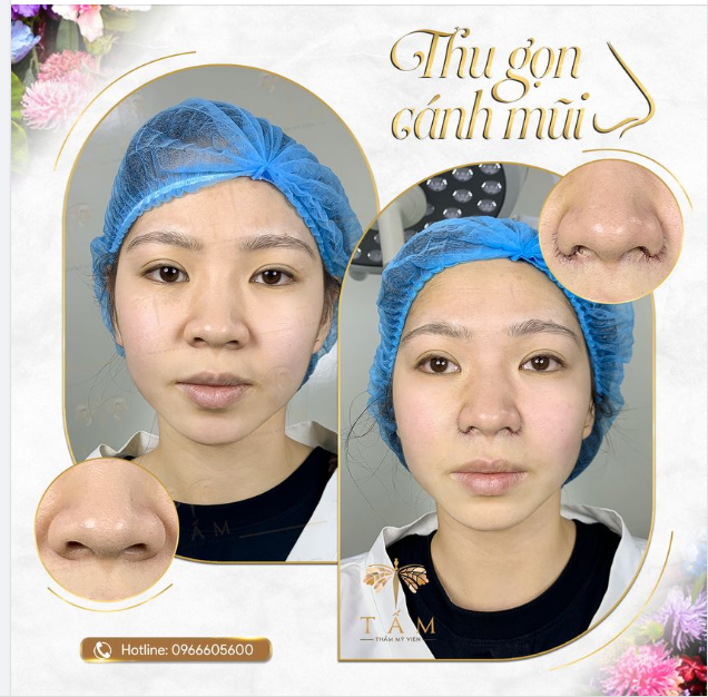 Hình ảnh trước sau nhìn trực diện cho thấy hiệu quả ngay sau làm dịch vụ thu gọn cánh mũi cho khách hàng.