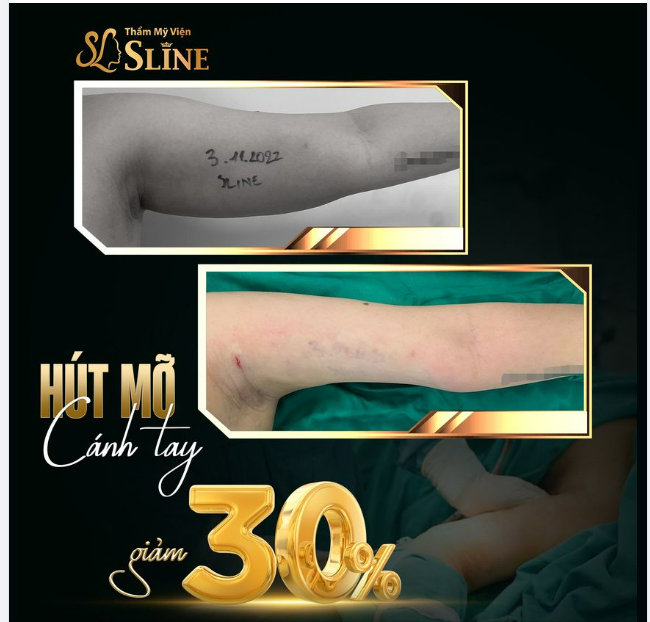 Kết quả vừa thực hiện xong với ekip Sline