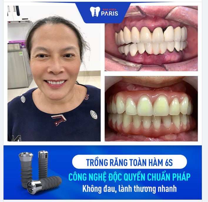 KHÁCH HÀNG TRỒNG RĂNG CÔNG NGHỆ 6S
