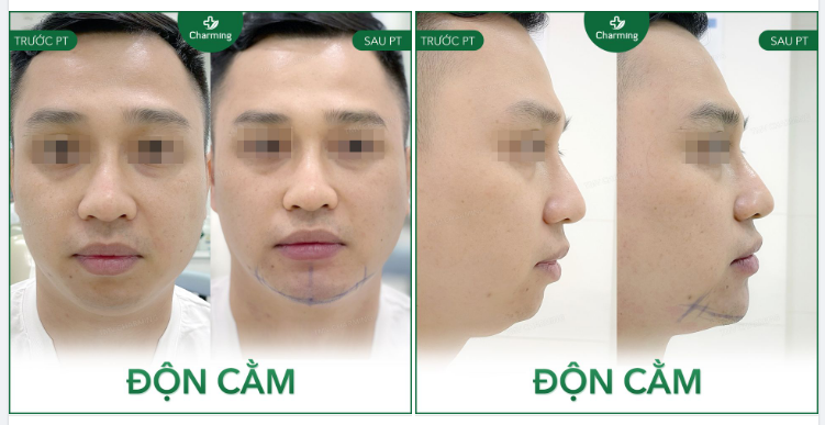 Khi khuôn mặt của bạn phát có chiều ngang mà lại còn thêm combo cằm ngắn, cằm lẹm thì khó tránh trường hợp khuôn mặt trông cứ “thiếu trước, hụt sau”.