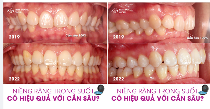 KHỎI CẮN SÂU HOÀN TOÀN NHỜ NIỀNG RĂNG