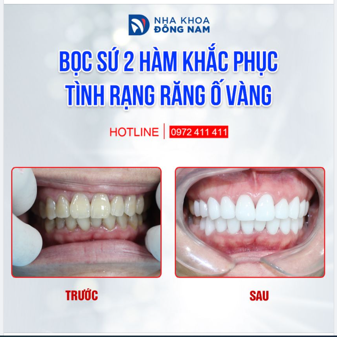 KHÔNG CAM TÂM CHỊU HÀM RĂNG SẪM MÀU CẢ ĐỜI, CHỊ M.HUYỀN (30 tuổi, quận 2) LỰA CHỌN BỌC SỨ THẨM MỸ ĐỂ NHẬN ĐƯỢC NHỮNG ĐIỀU TỐT ĐẸP HƠN
