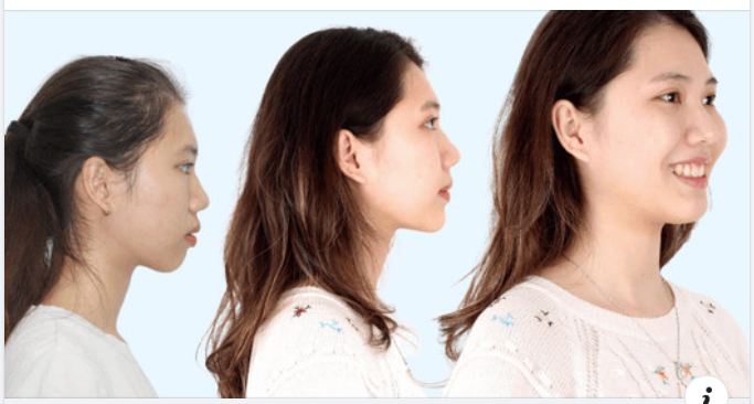 Không cần tới "dao kéo", chỉnh nha mới là chân ái cho tỉ lệ vàng mũi - môi - cằm