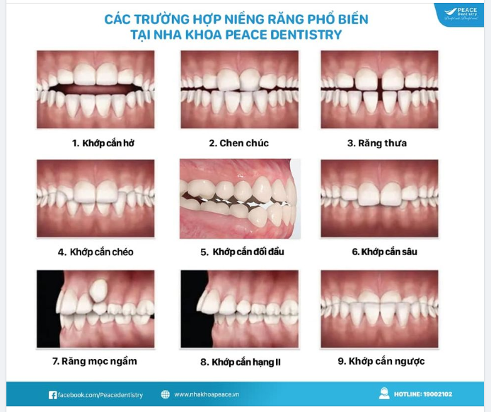 KHÔNG CHỈ KHẮC PHỤC  HÔ,  MÓM,  RĂNG KHẤP KHỂNH... NIỀNG RĂNG CÒN CHỈ ĐỊNH CHO RẤT NHIỀU TRƯỜNG HỢP KHÁC