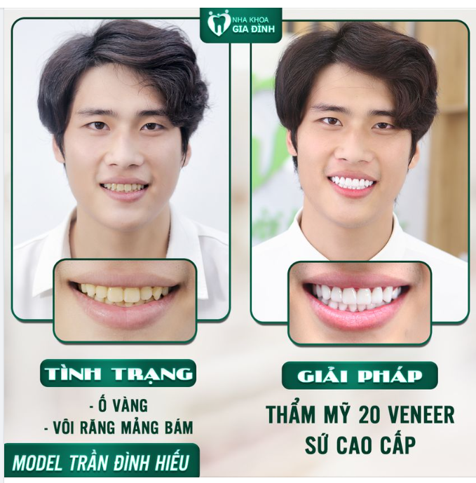 Không phải chỉ mình chị em phụ nữ mới cần làm đẹp, ngày nay các đấng mày râu cũng rất coi trọng nụ cười rạng rỡ, trắng sáng.
