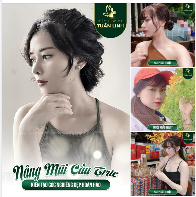 Kiến tạo góc nghiêng đẹp hoàn hảo với nâng mũi cấu trúc