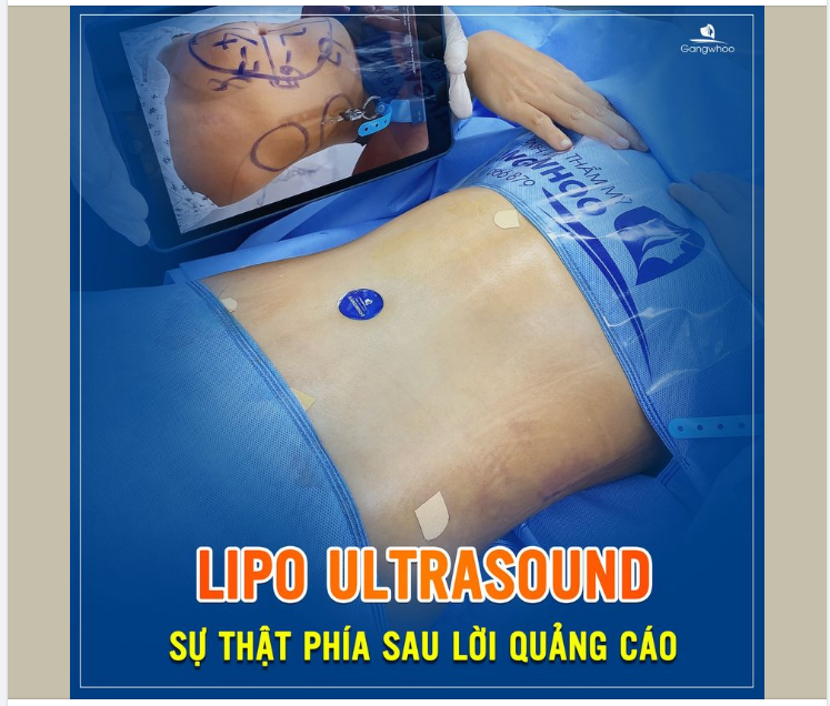 LIPO ULTRASOUND - SỰ THẬT PHÍA SAU LỜI QUẢNG CÁO