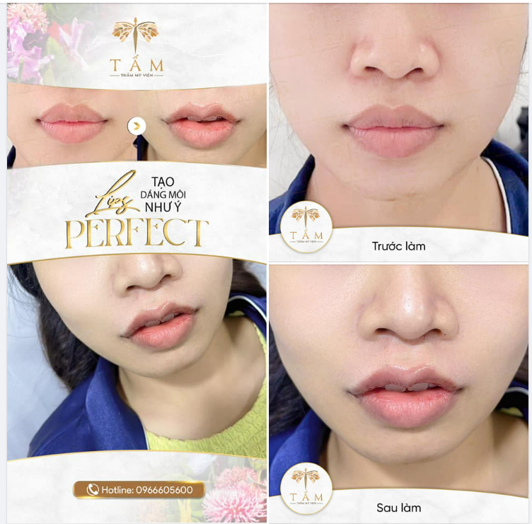 LIPS PERFECT - Tạo dáng môi như ý