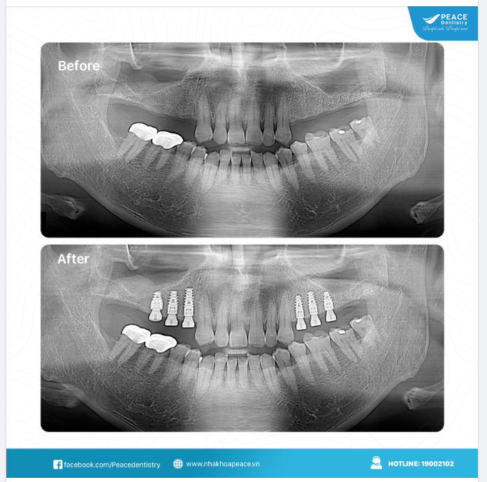 LỢI ÍCH CỦA VIỆC TRỒNG RĂNG IMPLANT