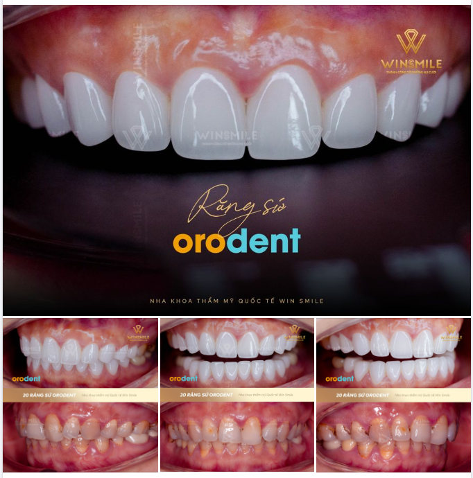 LỘT XÁC ĐẾN NGỠ NGÀNG CÙNG DÒNG SỨ ĐẲNG CẤP NHẤT HIỆN NAY