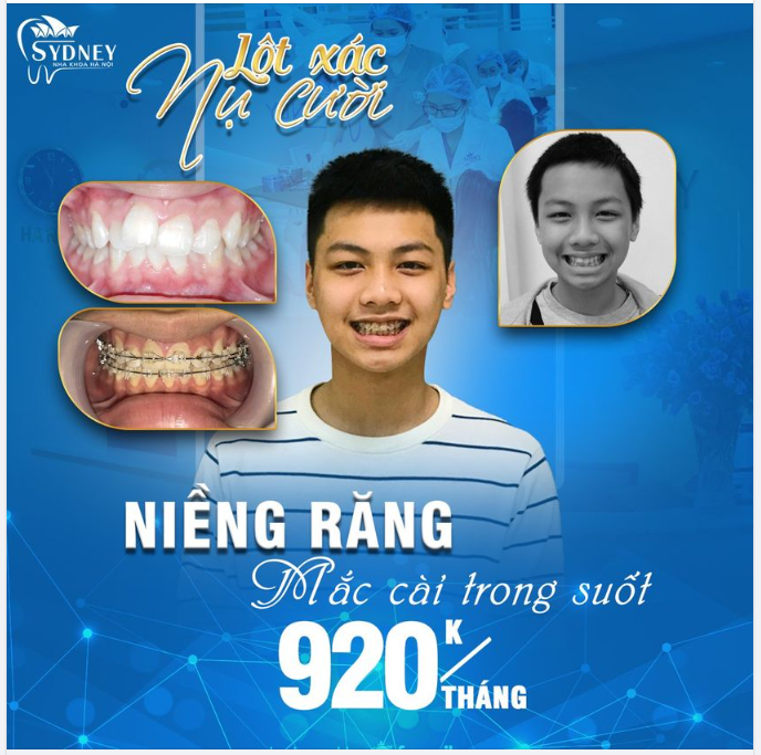 Lý do nên lựa chọn niềng răng bằng mắc cài pha lê trong suốt?