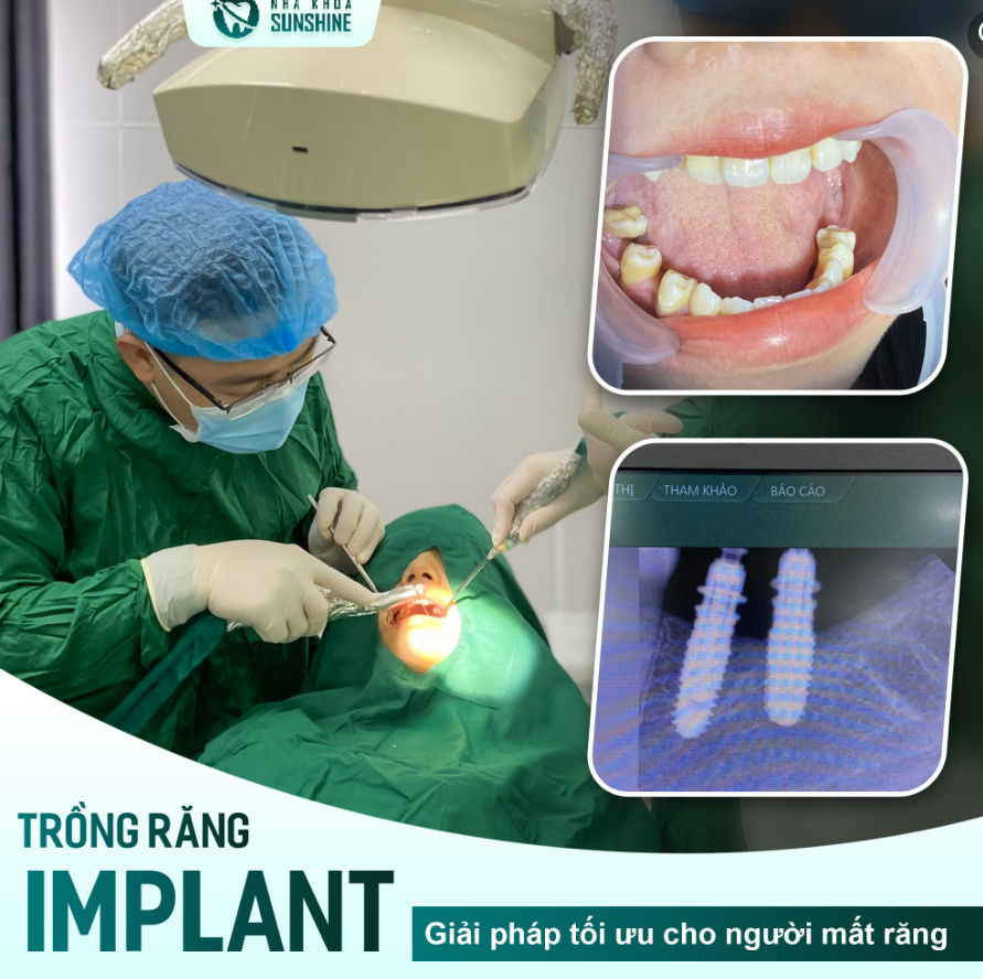 Mất răng không chỉ gây ảnh hưởng đến chức năng ăn nhai mà còn là nguyên nhân khiến cho các răng kề cận bị xô lệch, tiêu xương, hóp má và bị lão sớm.
