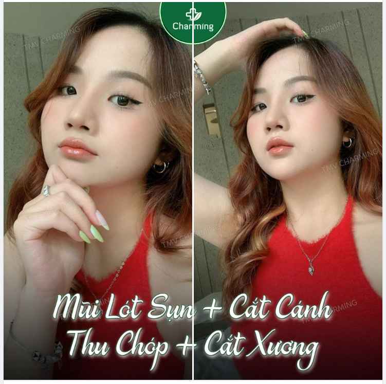 Một chiếc mũi cần cả một combo nâng mũi, thu chóp, cắt xương, cà gồ, cắt cánh thì bạn cũng đã có thể hình dung được chiếc mũi ấy như thế nào rồi đó