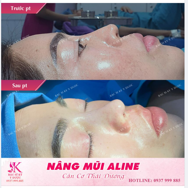 NÂNG MŨI ALINE CÂN CƠ THÁI DƯƠNG
