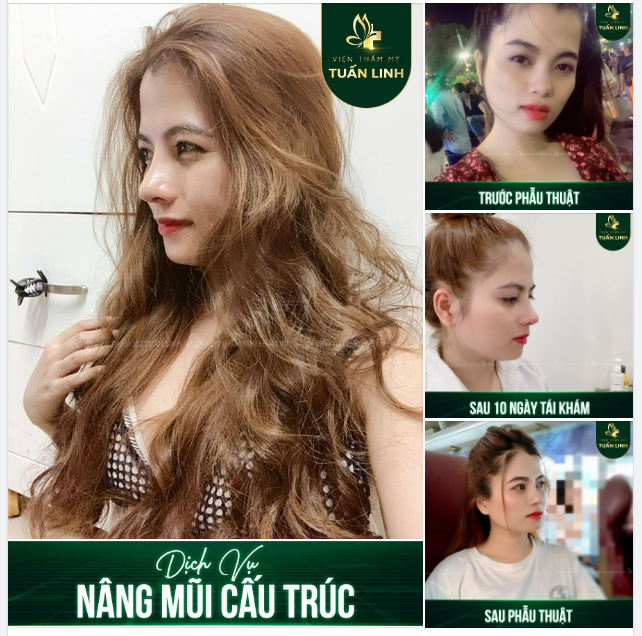 NÂNG MŨI CẤU TRÚC CHỈ 30 TR - TRẢ GÓP 0 LÃI SUẤT
