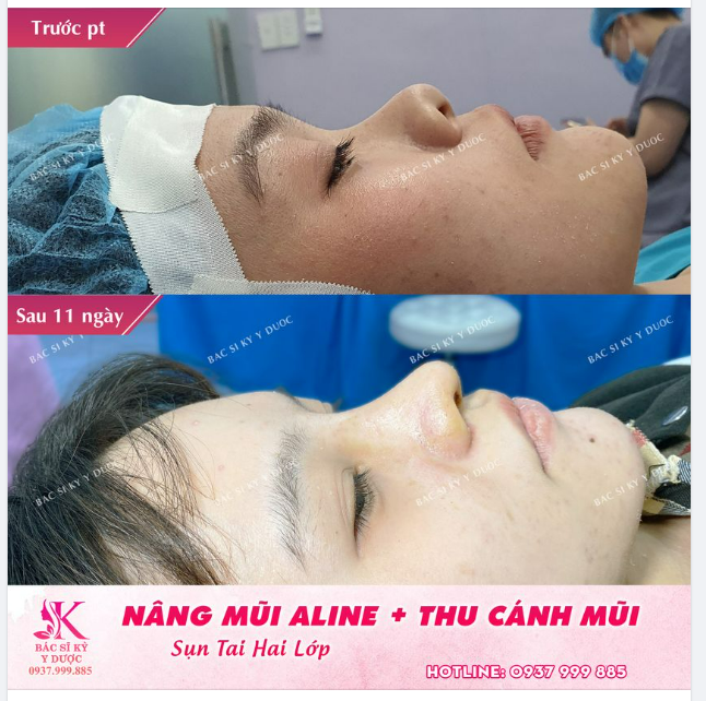 Nâng mũi sẽ giúp mũi được nâng cao lên và kéo dài ra, theo đó phần cánh mũi sẽ được kéo lên gọn hơn.