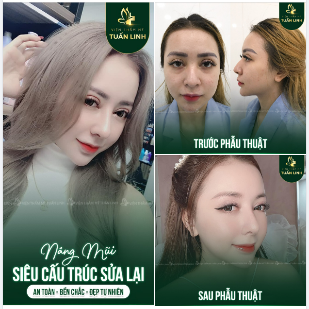 NÂNG MŨI SIÊU CẤU TRÚC - AN TOÀN - BỀN CHẮC - ĐẸP TỰ NHIÊN 