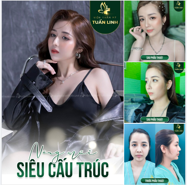 NÂNG MŨI SIÊU CẤU TRÚC ​​​​​​​ ĐỈNH CAO TẠO HÌNH MŨI ĐẸP