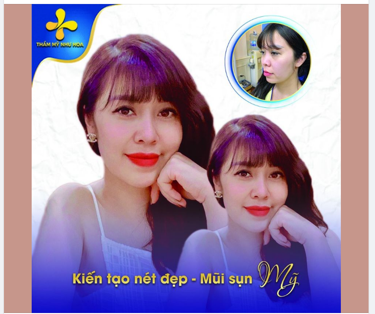 Nâng mũi sụn mỹ là dịch vụ nâng mũi chiếm nhiều thiện cảm của khách hàng khi mang lại vẻ đẹp độc đáo cho khách hàng.