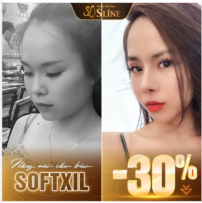 Nâng mũi tại Thẩm Mỹ Viện Sline 36A Lý Nam Đế