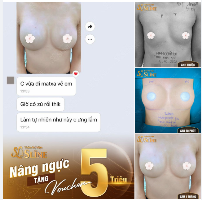 NÂNG NGỰC ƯU ĐÃI VÀNG