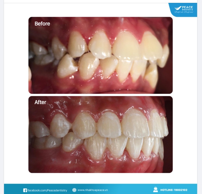 NẾU BẠN NGHĨ MÌNH ĐÃ QUÁ LỚN TUỔI ĐỂ NIỀNG RĂNG – HÃY SUY NGHĨ LẠI!