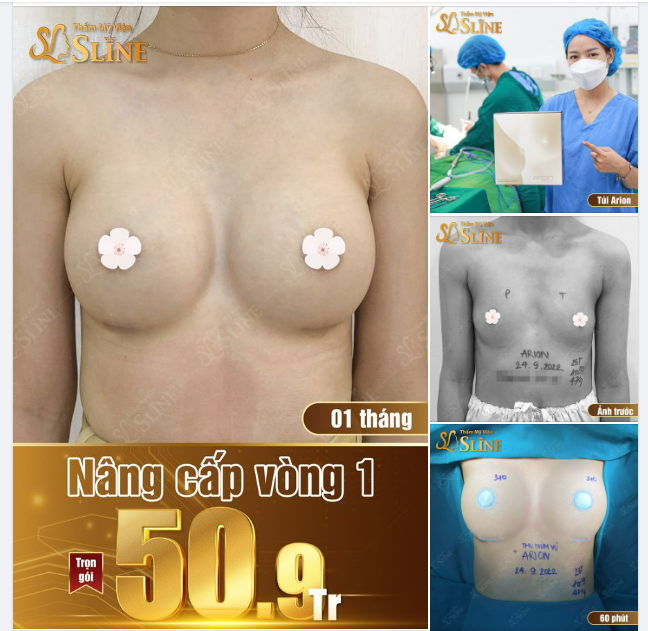 Ngỡ ngàng với Feedback nâng ngực sau 1 tháng.