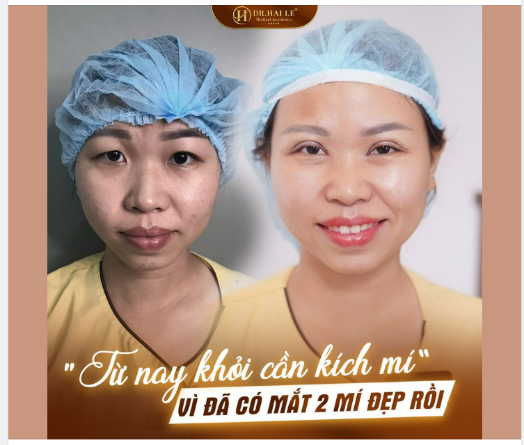 -Người ta dán 1 miếng kích mí thì mình dán tới tận 3 miếng mà cũng không có lên nổi mí.