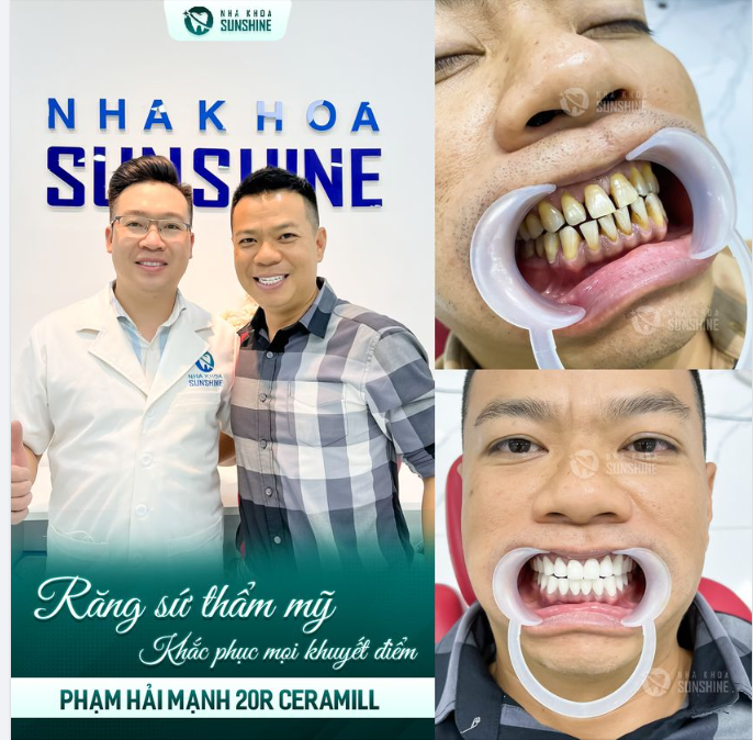Nhiều người trẻ muốn làm răng nhưng sợ đau.