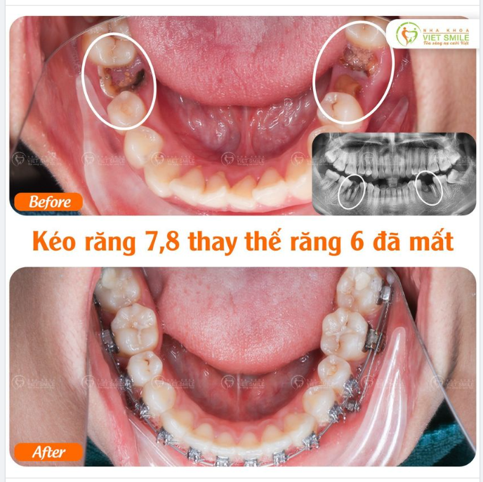 NIỀNG KÉO RĂNG 7,8 THAY THẾ RĂNG 6 ĐÃ MẤT