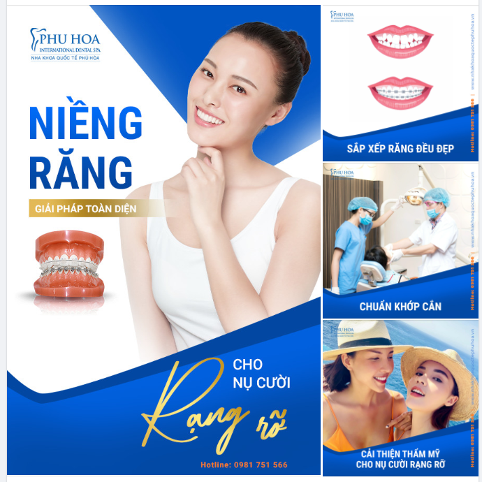 NIỀNG RĂNG – GIẢI PHÁP TOÀN DIỆN CHO NỤ CƯỜI RẠNG RỠ