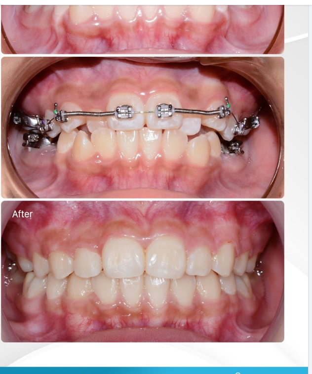 NIỀNG RĂNG GIẢI PHÁP TỐI ƯU CHO RĂNG CHEN CHÚC- KHẤP KHỂNH