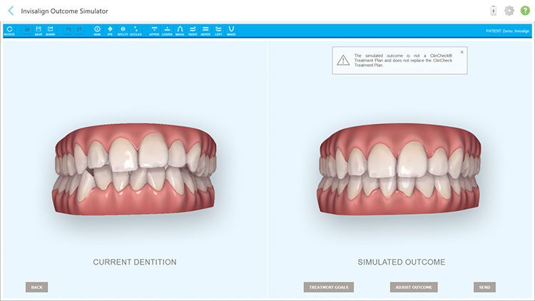 nieng-rang-invisalign-la-gi