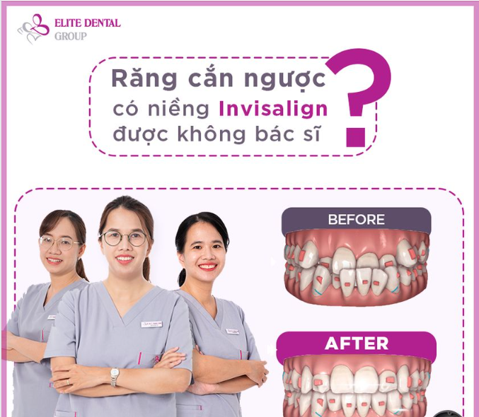 Niềng răng trong suốt có thể làm đều răng chen chúc, thay đổi cắn ngược được không?