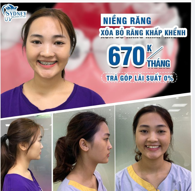 Niềng răng xóa bỏ hàm răng khấp khểnh