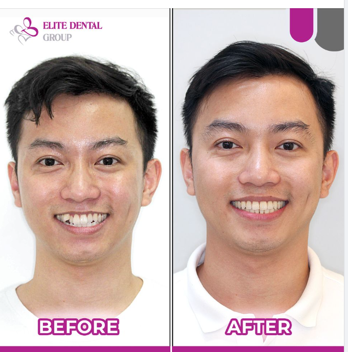 Nụ cười rạng rỡ sau chỉnh nha và còn hơn thế nữa